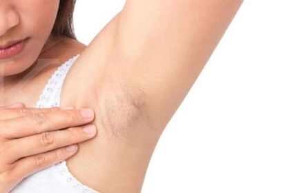 Kenapa Ketiak Gatal Setelah Pakai Deodoran?