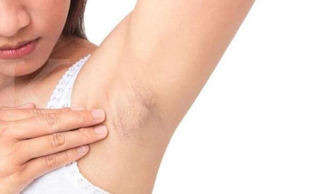Kenapa Ketiak Gatal Setelah Pakai Deodoran?