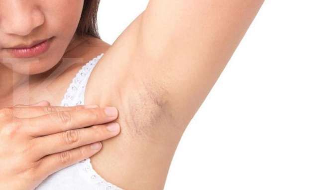 Kenapa Ketiak Gatal Setelah Pakai Deodoran?