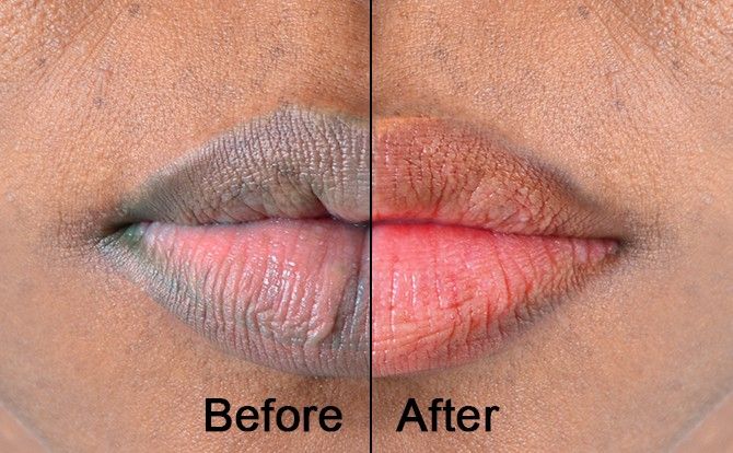 Cara Mencegah dan Mengatasi Bibir Hitam