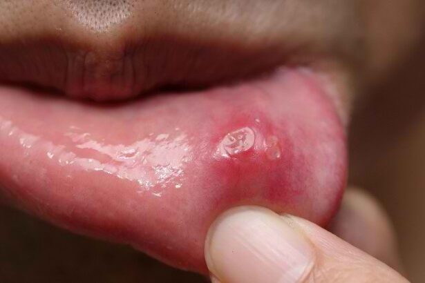 Sariawan dan Betadine: Bisakah Obat Merah Ini Membantu?