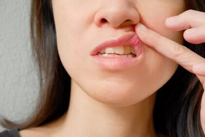 Jangan Khawatir: Begini Cara Cepat Hilangkan Sariawan