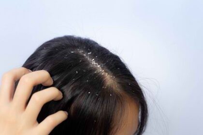 Atasi Ketombe dan Dapatkan Rambut Sehat Berkilau